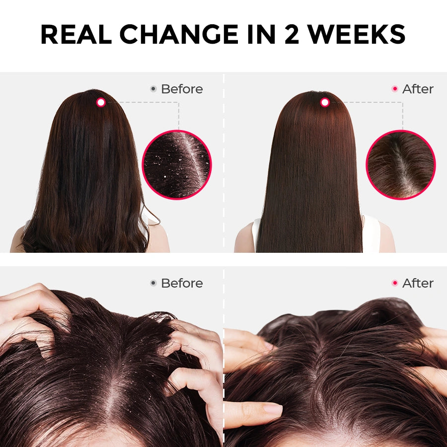 TYMO Anti Dandruff Shampoo Powder with rosemary shampoo extract for visible scalp improvement